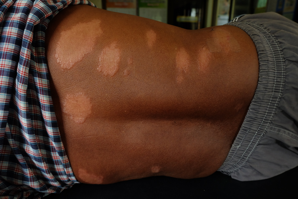 Leprosy's Drug Resistance and Origin Revealed by Genome Analysis Research & Development World