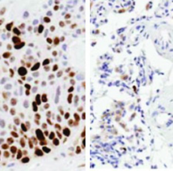 Potential Pancreatic Cancer Treatment May Increase Life