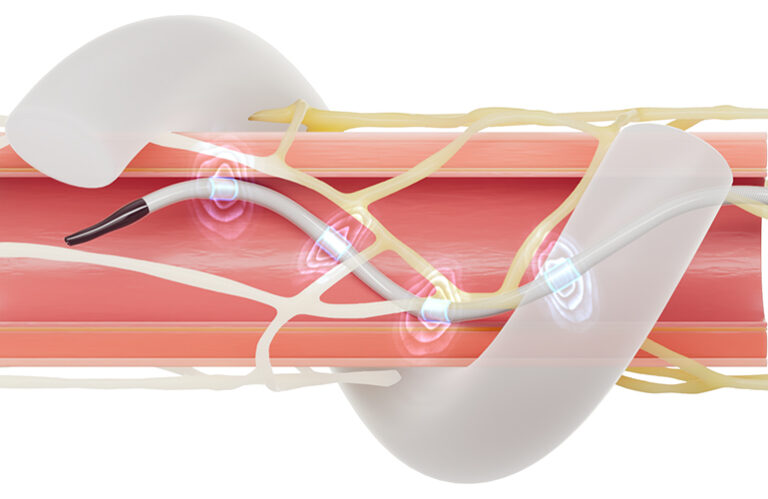 What Medtronic learned on its long road to RDN approval