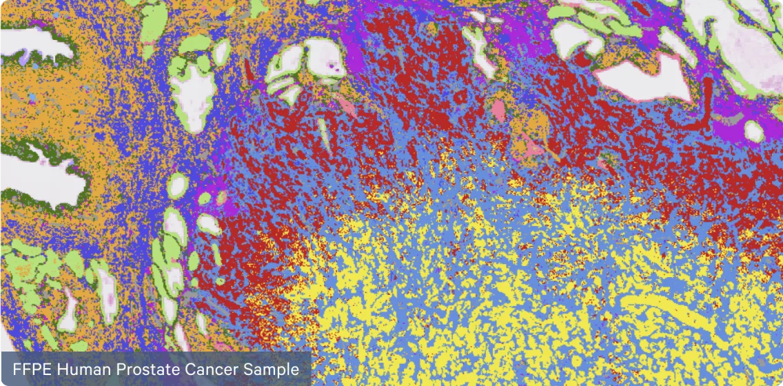 FPFE human prostate cancer sample