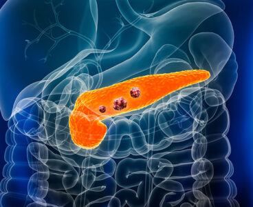 Pancreas or pancreatic cancer with organs and tumors or cancerous cells 3D rendering illustration with male body. Anatomy, oncology, disease, medical, biology, science, healthcare concepts.