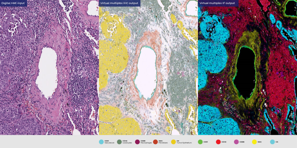 ViewsML generates virtual multiplex stains from a digital H&E image (left), predicting biomarkers per cell to map tumor epithelium, vasculature, and immune and stromal compartments, shown as virtual IHC (center) and immunofluorescence (right). Image courtesy of ViewsML.