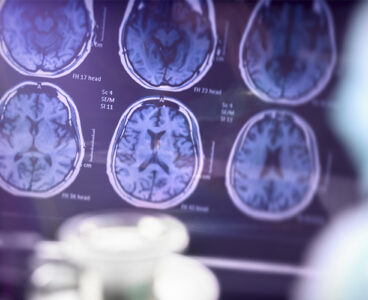 Operational discipline is a critical determinant of clinical utility for neurologic monoclonal antibodies